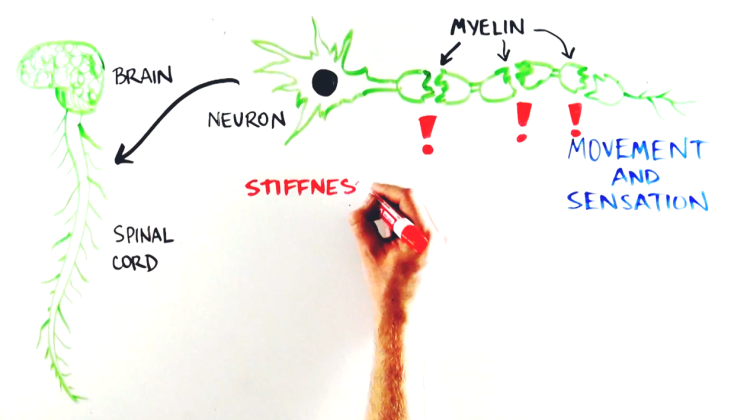 What is ALD? Adrenoleukodystrophy explained What is ALD? Adrenoleukodystrophy explained