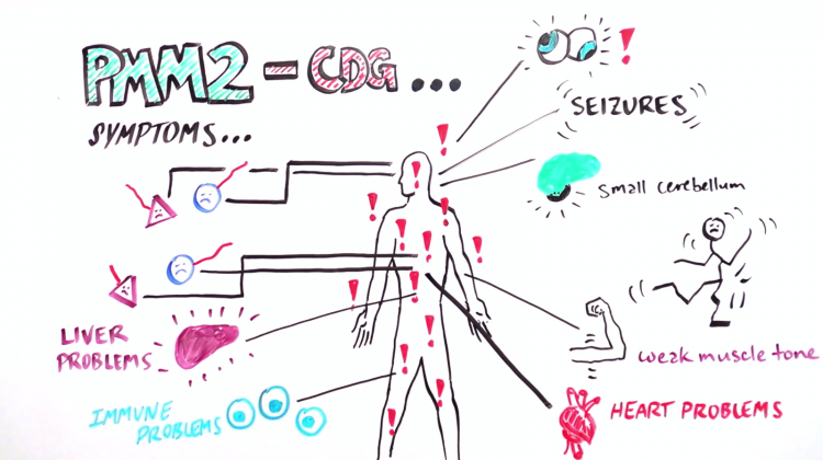 Congenital Disorders of Glycosylation: How missing “sugar trees” cause a rare disorder Congenital Disorders of Glycosylation: How missing “sugar trees” cause a rare disorder