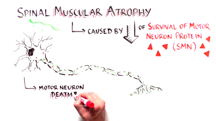 Cut and Paste: Treating Spinal Muscular Atrophy with Nusinersen Cut and Paste: Treating Spinal Muscular Atrophy with Nusinersen