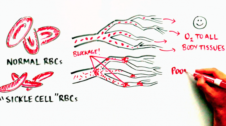 Progress and Promise of Stem Cell Research: Sickle Cell Disease Progress and Promise of Stem Cell Research: Sickle Cell Disease