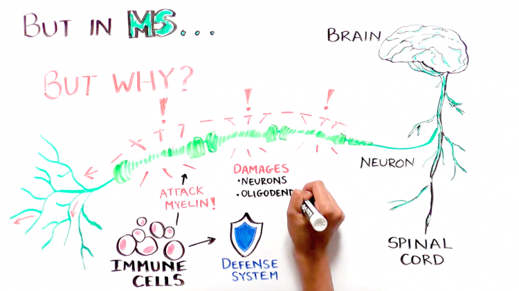 Progress and Promise of Stem Cell Research: Multiple Sclerosis Progress and Promise of Stem Cell Research: Multiple Sclerosis